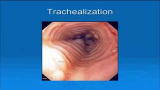 Eosinophilic Esophagitis Page [upl. by Tennek]