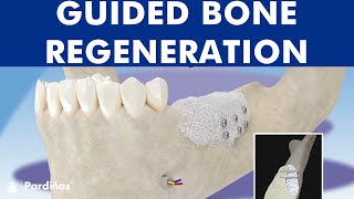 Guided bone regeneration  Bone graft © [upl. by Idelson]