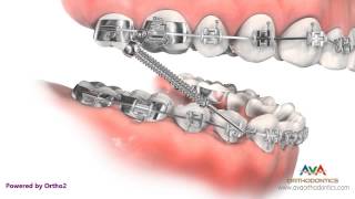 Orthodontic Treatment for Overjet Overbite  Forsus Appliance [upl. by Bosch]