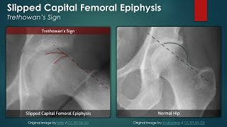 Slipped Capital Femoral Epiphysis Plain Radiography [upl. by Xylon386]