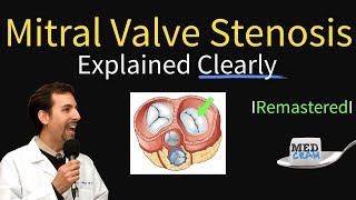 Mitral Valve Stenosis Diagnosis Treatment Pathophysiology [upl. by Siugram560]