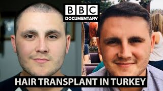 Hair Transplant Turkey  BBC Documentary  Paul Before amp After [upl. by Norraf]