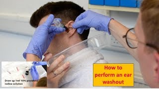 How to Perform an Ear Washout irrigation  ENTOtolaryngology Skills [upl. by Anelec]