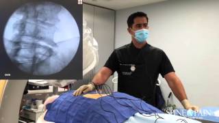 Radiofrequency Ablation Procedure [upl. by Aliza]