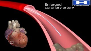 ANGIOPLASTY PROCESS [upl. by Mikol]