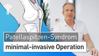 Patellaspitzensyndrom OP Knieschmerzen loswerden durch Operation des JumpersKnee [upl. by Ailliw591]