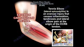 Tennis Elbow Extensor Carpi Radialis Brevis Everything You Need To Know  Dr Nabil Ebraheim [upl. by Yehus]