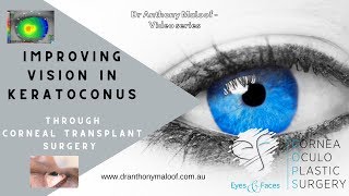 Improving vision in Keratoconus through corneal transplant surgery Dr Maloof Sydney Australia [upl. by Seraphine]