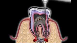 Wurzelbehandlung beim Zahnarzt [upl. by Darken99]