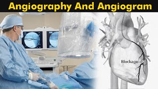 Angiogram Procedure Risks and Benefits [upl. by Inanuah]