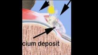 Calcium Removal [upl. by Zoeller]