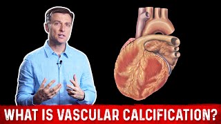 What Is Vascular Calcification – DrBerg [upl. by Odnalro12]