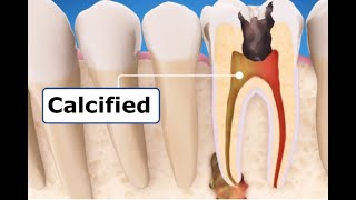 Molar Root Canal  Calcified Canals [upl. by Aldwin]