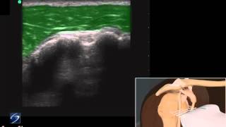 How To Shoulder Biceps Tendon 3D Video [upl. by Mona]