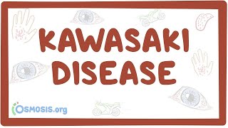 Kawasaki disease  an Osmosis Preview [upl. by Tabatha]