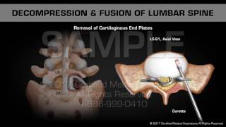 Decompression amp Fusion of Lumbar Spine [upl. by Cagle]