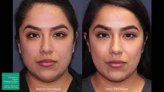 Thermage Skin Tightening Treatment by Leysin Fletcher PAC  Cosmetic Laser Dermatology San Diego [upl. by Cullan]