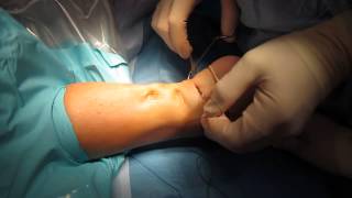 Percutaneous Achilles Tendon Surgery Repair Unedited by Kevin R Stone MD [upl. by Dnamra693]