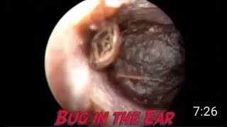 Insect inside the ear [upl. by Nylkoorb]