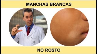 MANCHAS BRANCAS NO ROSTO Pitiríase alba  Como combater Por Luiz Gameiro dermatologista [upl. by Placidia]