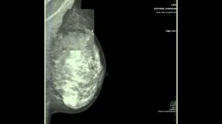 Breast Imaging Boot Camp Calcifications [upl. by Naara]