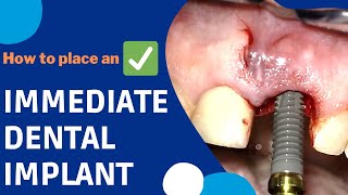 How is an IMMEDIATE DENTAL IMPLANT surgery done implants [upl. by Canada]