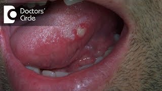 What are different circularlesions present on tongue  Dr Jayaprakash Ittigi [upl. by Aivila]