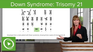 Down Syndrome Trisomy 21 – Medical Genetics  Lecturio [upl. by Elyrehc787]