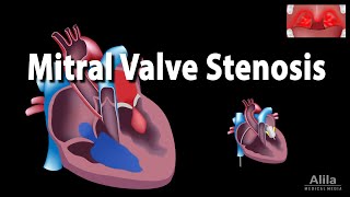 Mitral Valve Stenosis Animation [upl. by Floridia704]