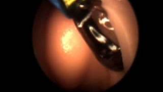 Balloon Sinuplasty for Chronic Sinusitis [upl. by Suivatnod368]