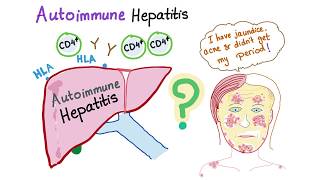 Autoimmune Hepatitis Lupoid hepatitis [upl. by Jauch545]