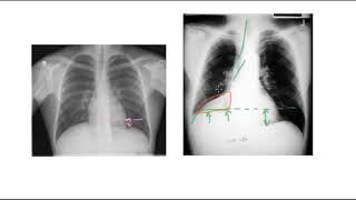 🔴 PNEUMONIE PLEURESIE INFARCTUS OU ATELECTASIE [upl. by Gerta466]