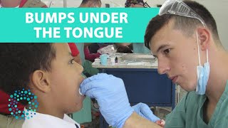 BUMPS UNDER THE TONGUE Symptoms amp Causes [upl. by Ertha8]