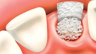 Bone grafting procedure [upl. by Pearman]