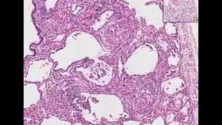 Histopathology LungSarcoidosis [upl. by Zel]