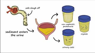 Lupus Nephritis  A to Z Guide [upl. by Yrolam185]