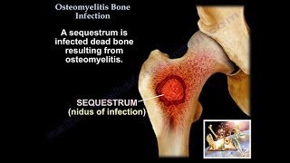 Eosinophilic Granuloma Vertebral Plana  Everything You Need To Know  Dr Nabil Ebraheim [upl. by Flossie]