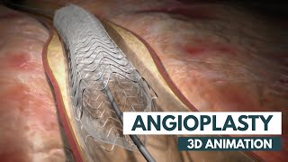 Learn about Atherosclerosis  3D Animation [upl. by Aleydis]