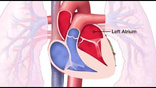 Mitral Valve Regurgitation [upl. by Keyser]