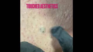 Episode 2 ingrown hair extractions [upl. by Veronike624]