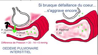 Oedème aigu pulmonaire [upl. by Ehudd271]