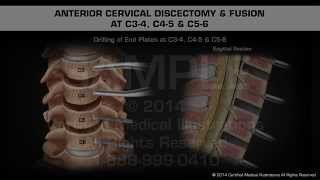 Anterior Cervical Discectomy amp Fusion at C34 C45 amp C56 [upl. by Hevak]